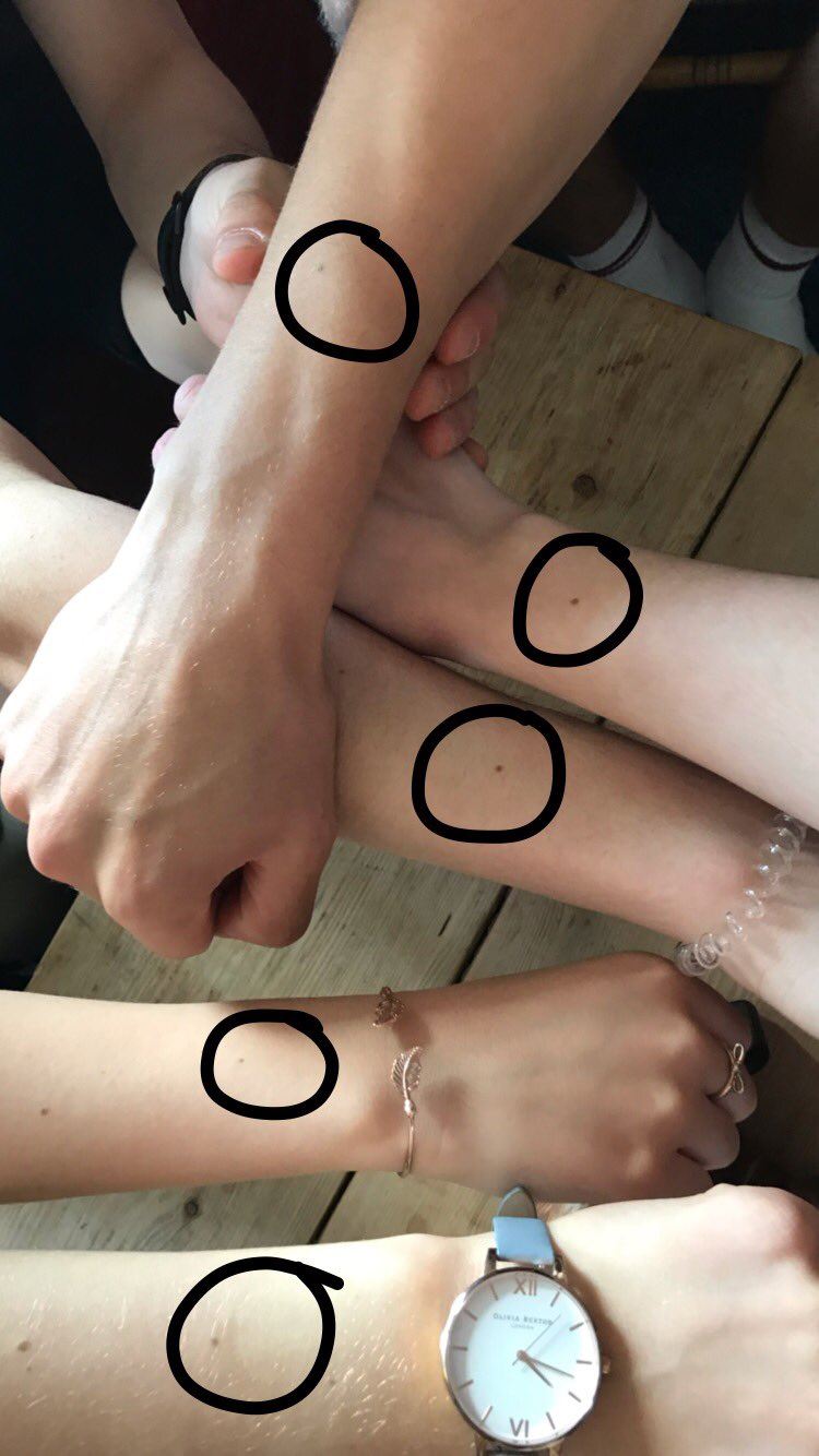 girls apparently have a freckle at the same spot and everyone’s freaking out
