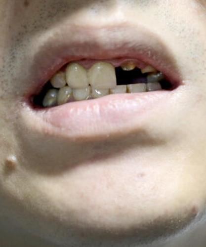 man breaks two teeth after biting into stone in his tasty bun