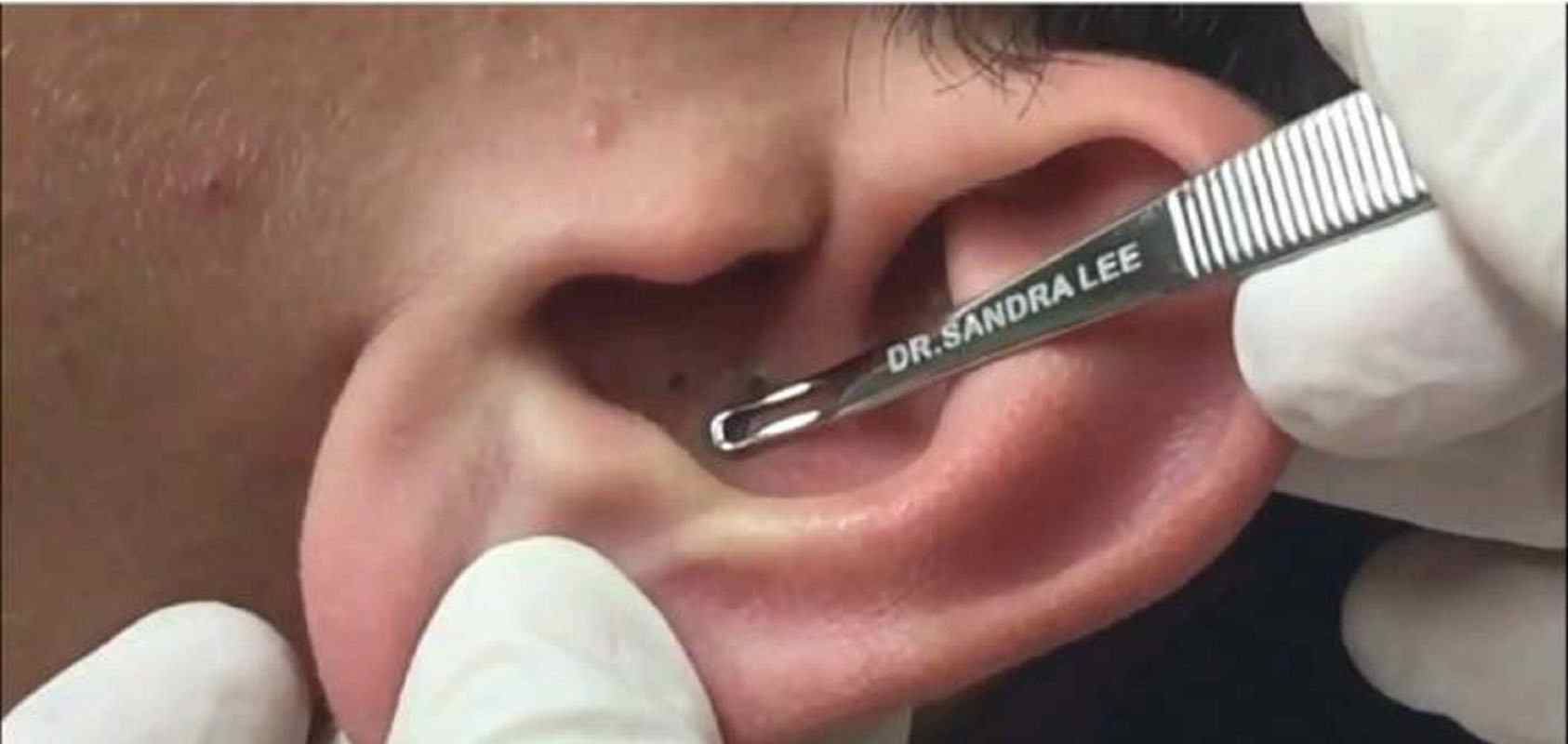 wearing headphones for too long can create blackheads inside your ear