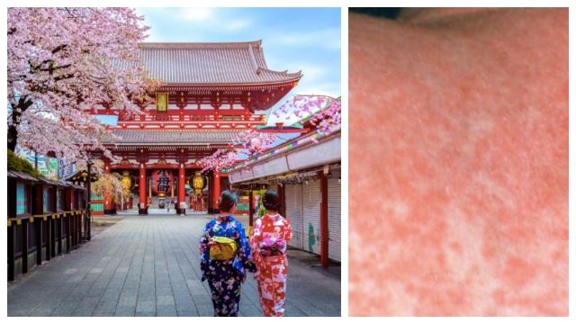 日本爆发德国麻疹疫情！东京疫情最严重！