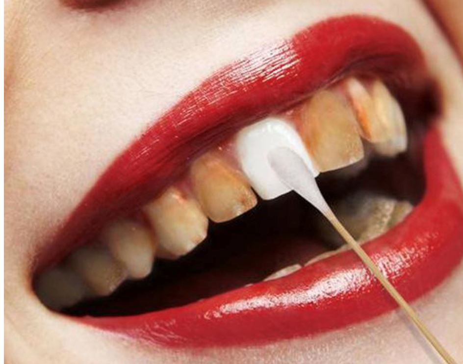 轻松告别黄牙齿！教你2分钟去除牙齿污垢！