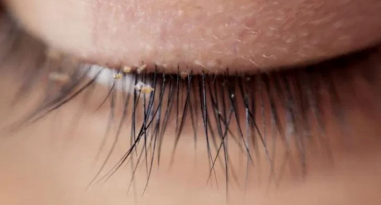 小心！植睫毛怕掉落疏于清洁恐细菌感染长虱子! 