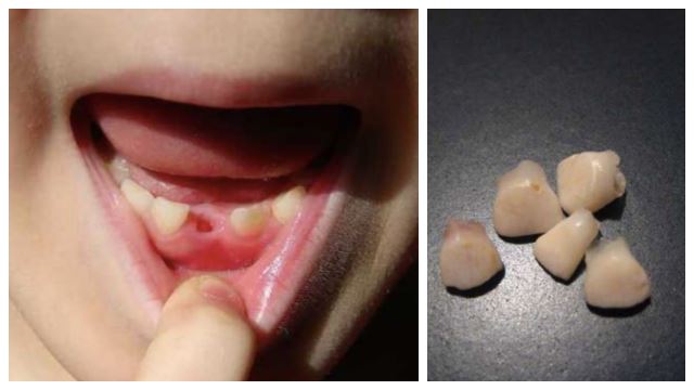 医生说小孩掉落的乳牙别再丢掉？它竟然可以救一命？！