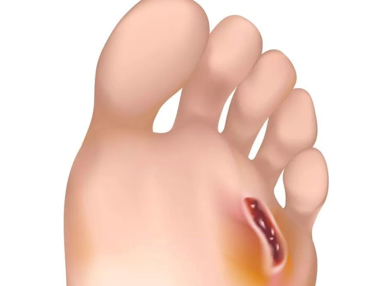 不妥善对待糖尿病! 小心后果很严重!