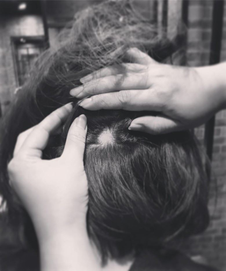 压力大到脱发！高海宁被“鬼剃头”头上出现两个洞