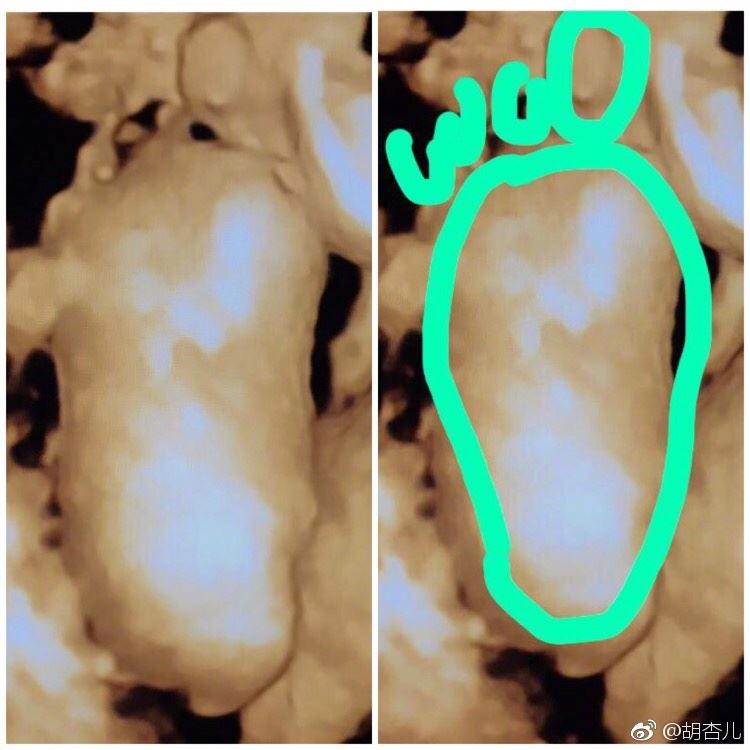 首次晒b超照 宝宝脚太大！胡杏儿吓呆：难怪踢我这么疼