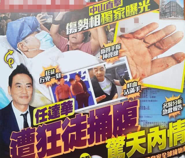 任达华右手伤口曝光！四只手指神经被割断