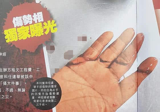 任达华右手伤口曝光！四只手指神经被割断