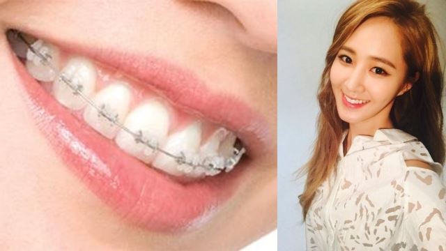 爱美是需要付出代价的!绑牙の痛苦有谁知!