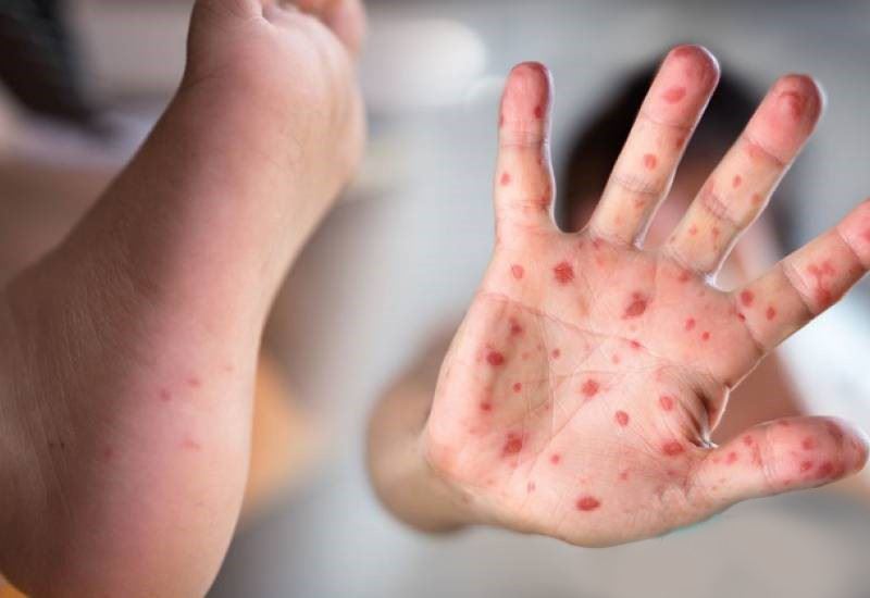 焦点新闻：若手足口症病例继续升，托儿所和幼儿园将被关闭。