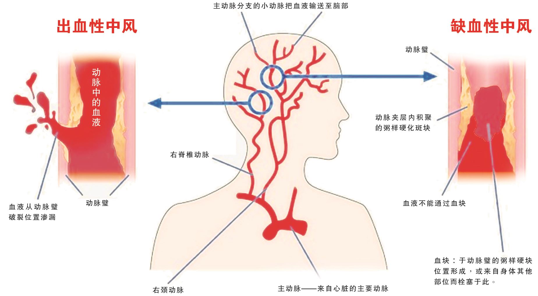 特别报道:年轻人中风剧增,辨别征兆很重要,黄金4小时可救命!