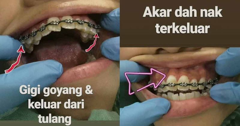 pendakap gigi tiruan dan murahan boleh menyebabkan jangkitan hiv