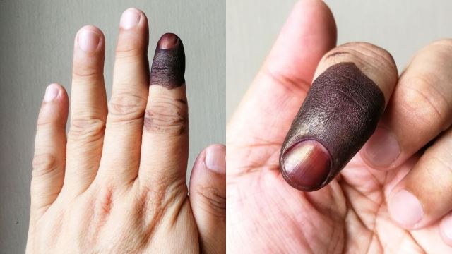 dah selesai mengundi? ini cara mudah hilangkan dakwat kekal pada jari