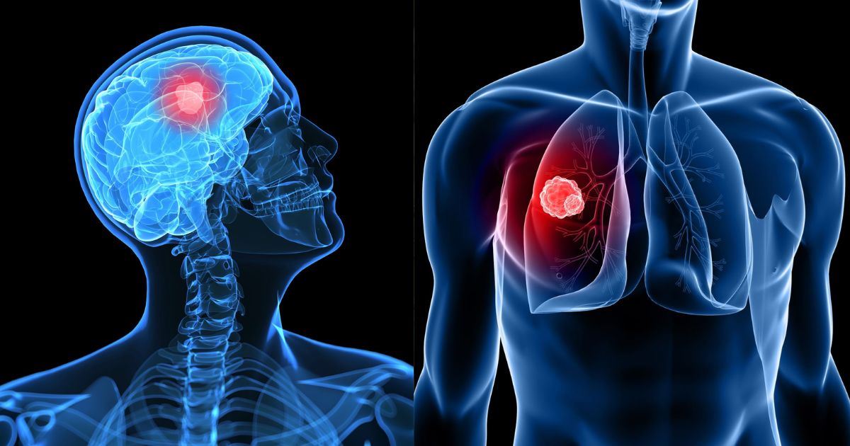 Senarai 5 Kanser Paling Agresif Yang Ramai Tak Sedar, Ada Yang Merebak Dalam Masa Singkat!