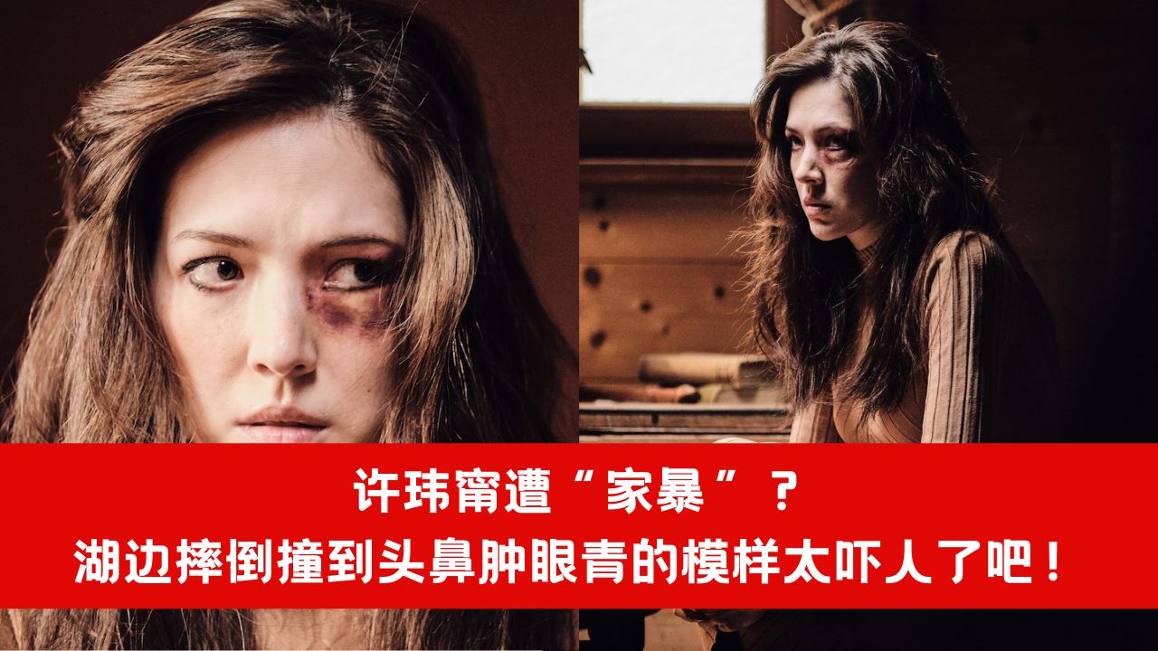 【台娱】许玮甯遭“家暴”？湖边摔倒撞到头鼻肿眼青的模样太吓人了吧！ 