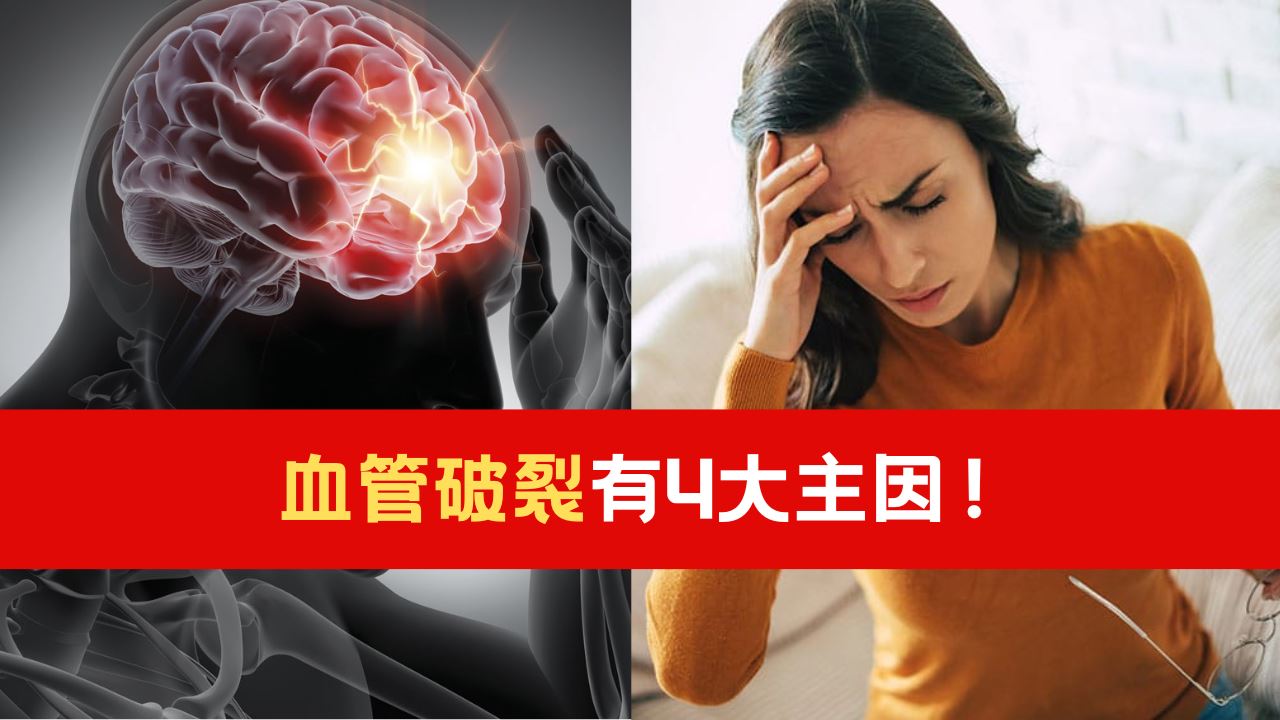血管破裂有4大主因！医生：脑动脉瘤无征兆！