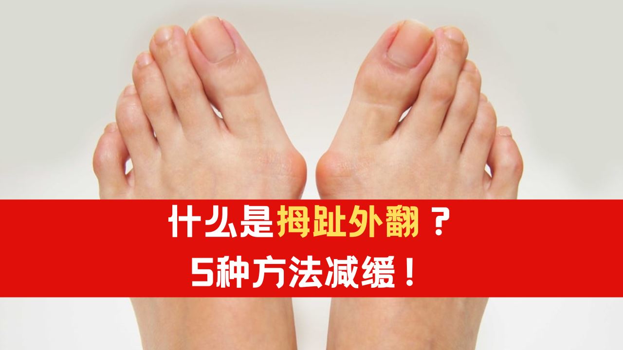 什么是【拇趾外翻】?5种方法减缓拇趾外翻!