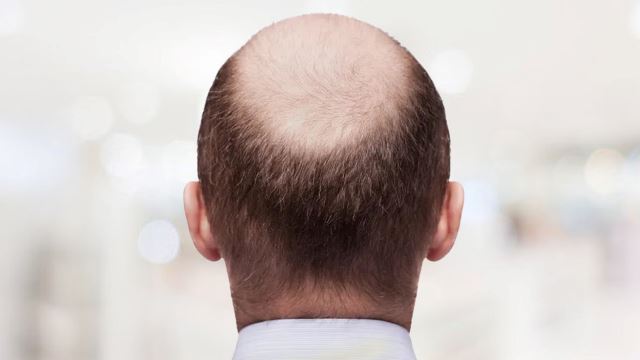 Calling Your Colleague Bald Is Now Considered Sexual Harassment In The UK