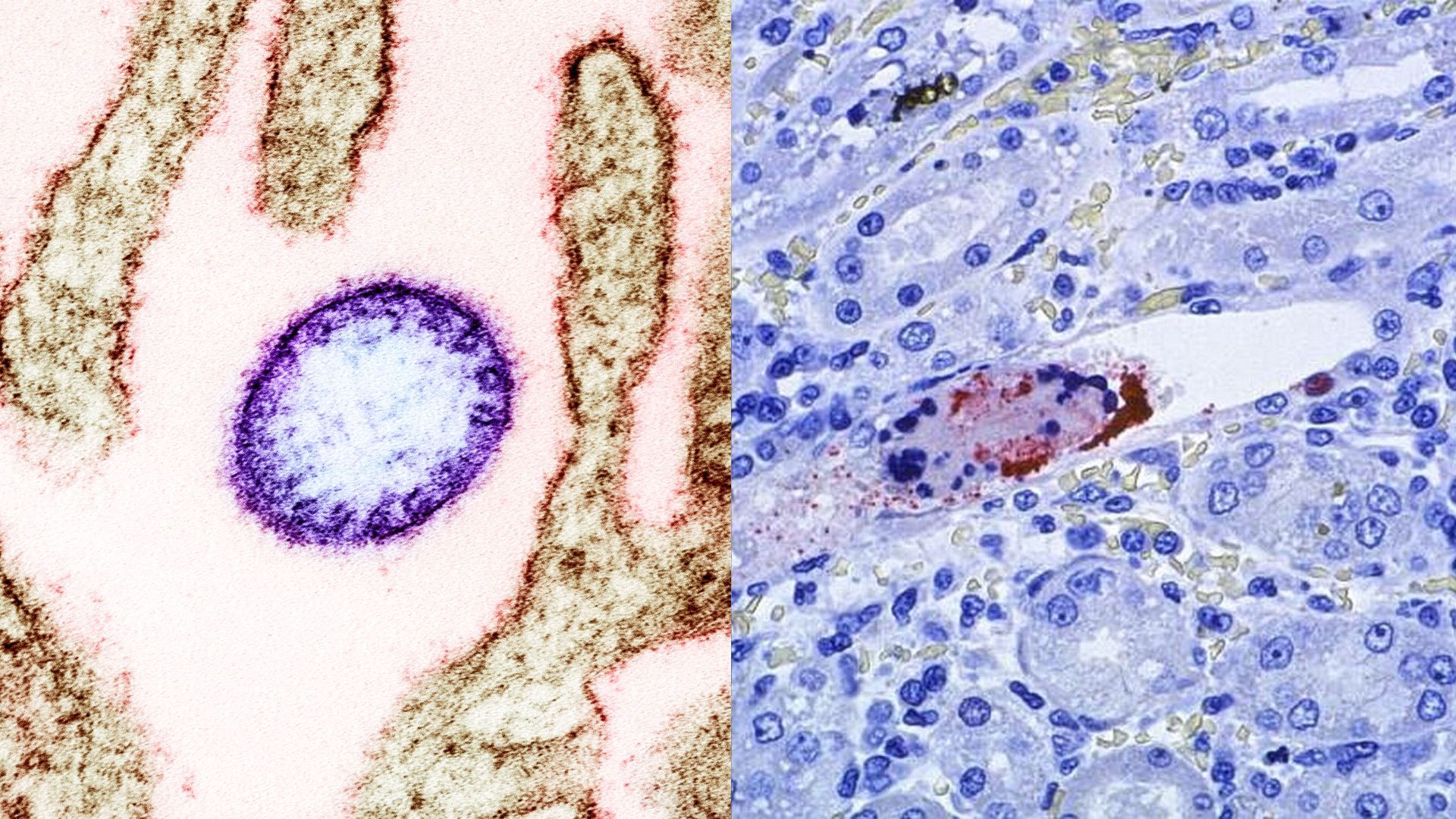 Virus Nipah Sukar Berjangkit Tetapi Kadar Kematian Tinggi